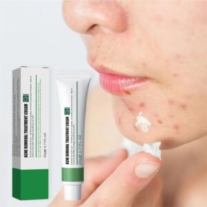 Anti Acne / Anti Pimple Cream