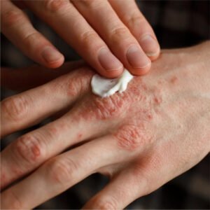 Eczema Cream
